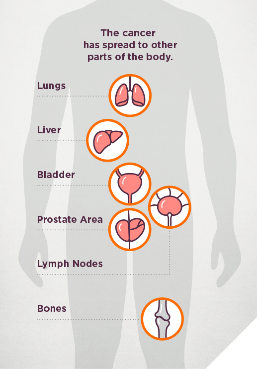 Prostate Cancer Progression Know Your Prostate Plan